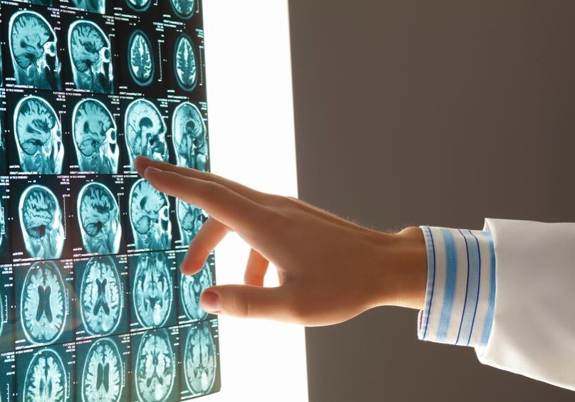 brain injury MCIS Lawyers